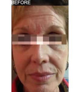 Botox