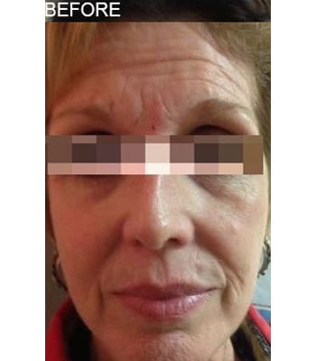 Before Image: Botox - front