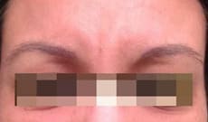 After Image: Botox - front