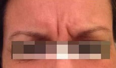 Before Image: Botox - front