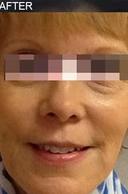 After Image: Dermal Filler - front