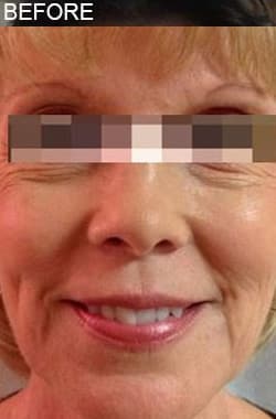 Before Image: Dermal Filler - front