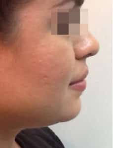 Dermal Filler