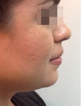 After Image: Dermal Filler - right-side