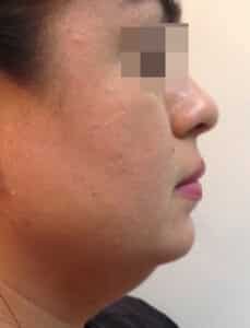 Dermal Filler