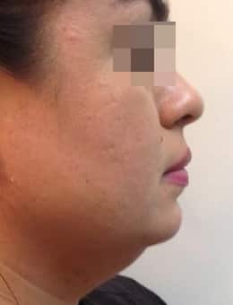 Before Image: Dermal Filler - right-side