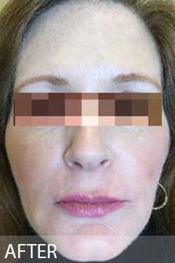 After Image: Facelift - front