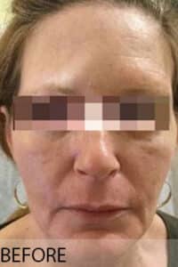 Before Image: Facelift