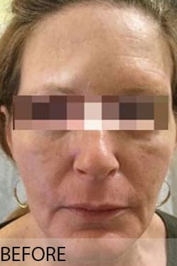 Before Image: Facelift - front