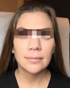 After Image: Dermal Filler