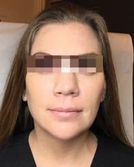 After Image: Dermal Filler - front