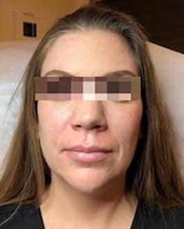 Before Image: Dermal Filler - front