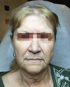 Before Image: Dermal Filler - front