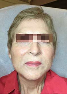 After Image: Dermal Filler - front