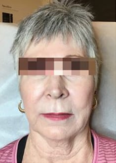After Image: Dermal Filler - front