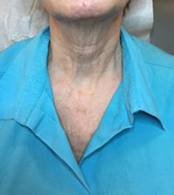 After Image: Fractora - front