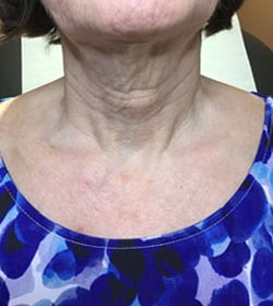 Before Image: Fractora - front