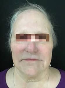 After Image: IPL/Photofacial