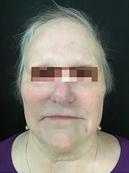 After Image: IPL/Photofacial - front