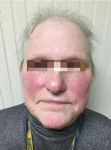 Before Image: IPL/Photofacial