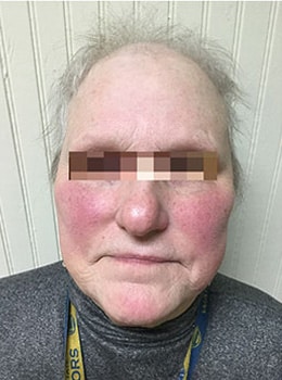 Before Image: IPL/Photofacial - front