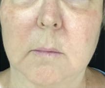 After Image: IPL/Photofacial - front