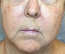 Before Image: IPL/Photofacial - front