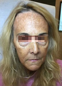 IPL/Photofacial