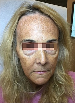 Before Image: IPL/Photofacial - front