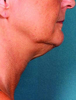 Before Image: Kybella - right-side