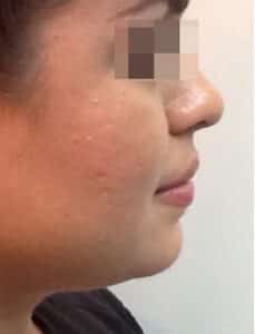 After Image: Kybella
