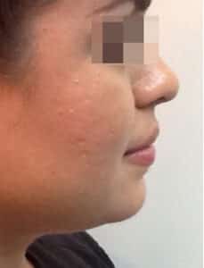 Kybella