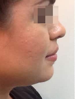 After Image: Kybella - right-side