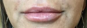 After Image: Lip Filler