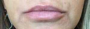 Before Image: Lip Filler