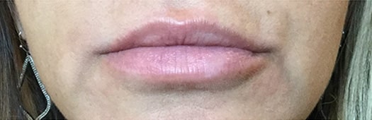 Before Image: Lip Filler - front