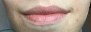 Before Image: Lip Filler