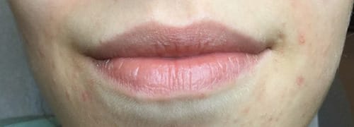 Before Image: Lip Filler - front