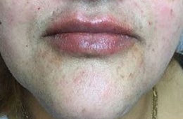 After Image: Lip Filler - front