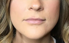After Image: Lip Filler - front
