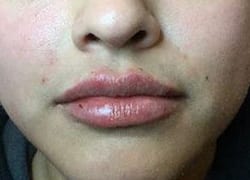 After Image: Lip Filler - front