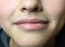 Before Image: Lip Filler - front