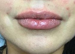 After Image: Lip Filler - front