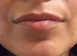 Before Image: Lip Filler - front