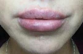After Image: Lip Filler - front