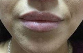 Before Image: Lip Filler - front