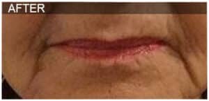 Lip Filler