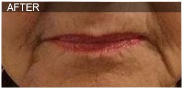 After Image: Lip Filler - front