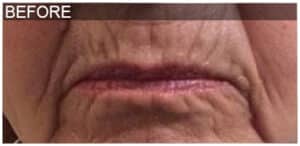 Lip Filler