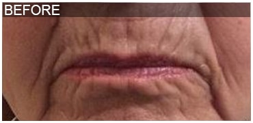 Before Image: Lip Filler - front